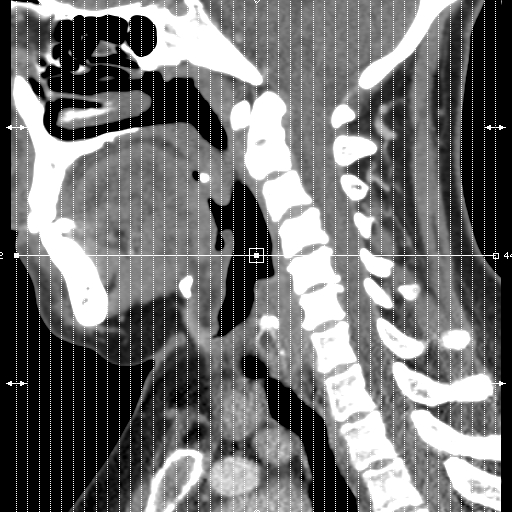 File:Carotid body tumor (paraganglioma) (Radiopaedia 38586-40729 B 1).jpg