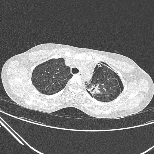 Catamenial pneumothorax (Radiopaedia 27946-28197 lung window 46).jpg