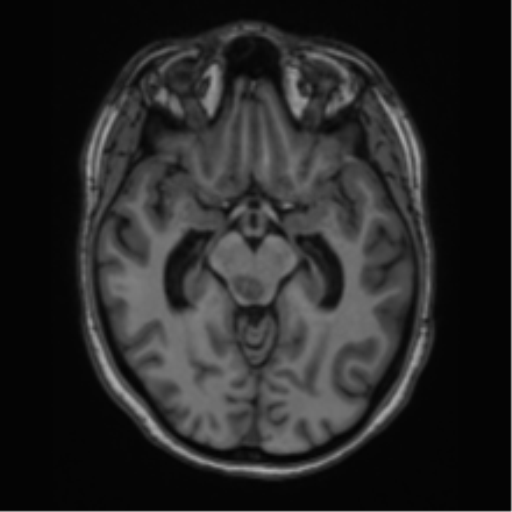 Cavernoma with bleed - midbrain (Radiopaedia 54546-60774 Axial T1 15).png