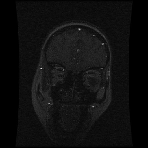 Cavernoma with developmental venous anomaly (Radiopaedia 22470-22507 MRV 103).jpg