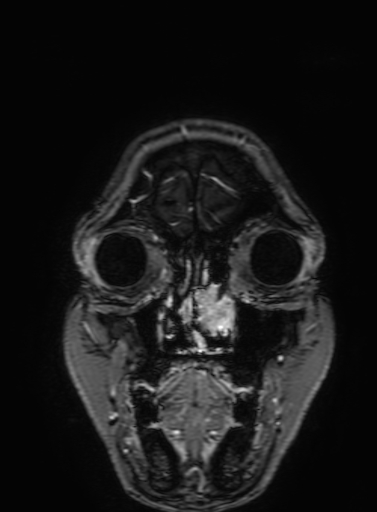 Cavernous hemangioma of the cerebellar falx (Radiopaedia 73025-83724 Coronal T1 C+ 33).jpg