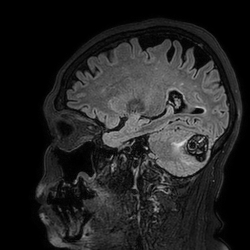 Cavernous hemangioma of the cerebellar falx (Radiopaedia 73025-83724 Sagittal FLAIR 147).jpg