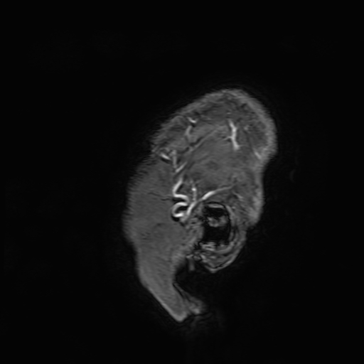 File:Cavernous hemangioma of the cerebellar falx (Radiopaedia 73025-83724 Sagittal T1 C+ 1).jpg