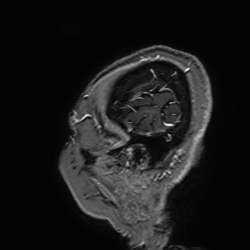 Cavernous hemangioma of the cerebellar falx (Radiopaedia 73025-83724 Sagittal T1 C+ 16).jpg