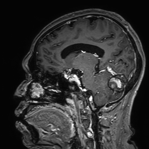 File:Cavernous hemangioma of the cerebellar falx (Radiopaedia 73025-83724 Sagittal T1 C+ 91).jpg