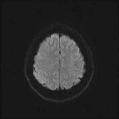 Cavernous sinus meningioma (Radiopaedia 63682-72367 DWI 58).jpg