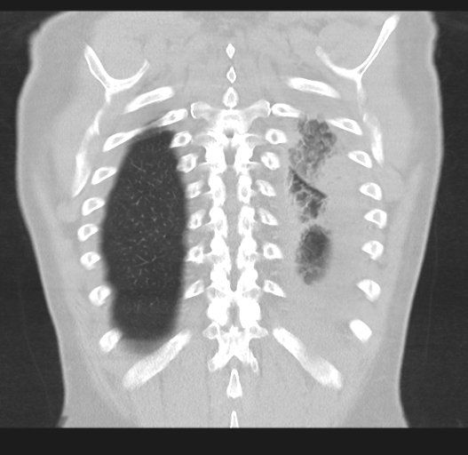 Cavitating pneumonia complicated by pneumothorax (Radiopaedia 48149-52994 Coronal lung window 49).png