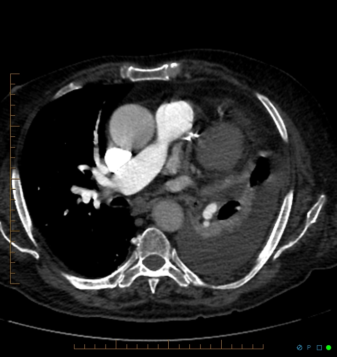 Cavitating pulmonary infarction (Radiopaedia 54634-60849 Axial C+ CTPA 39).jpg