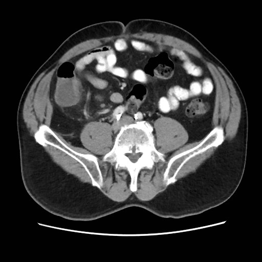 File:Cecal mass causing appendicitis (Radiopaedia 59207-66531 A 57).jpg