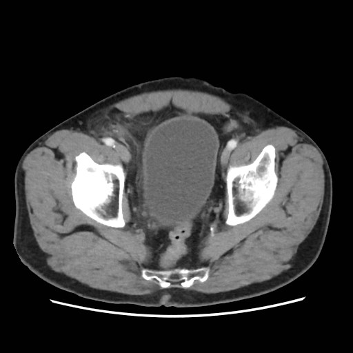 Cecal mass causing appendicitis (Radiopaedia 59207-66531 A 78).jpg