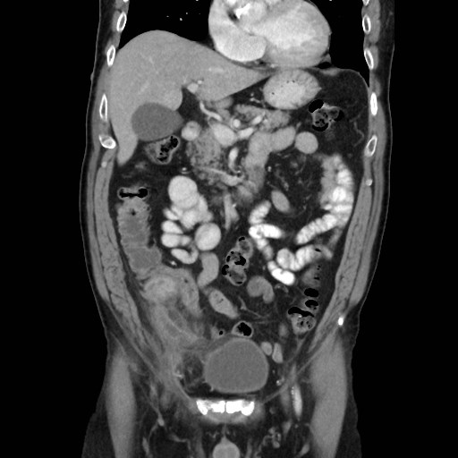 Cecal mass causing appendicitis (Radiopaedia 59207-66531 B 20).jpg