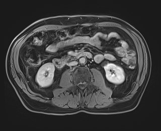 Cecal mass causing appendicitis (Radiopaedia 59207-66532 J 69).jpg