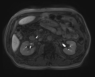 Cecal mass causing appendicitis (Radiopaedia 59207-66532 K 56).jpg