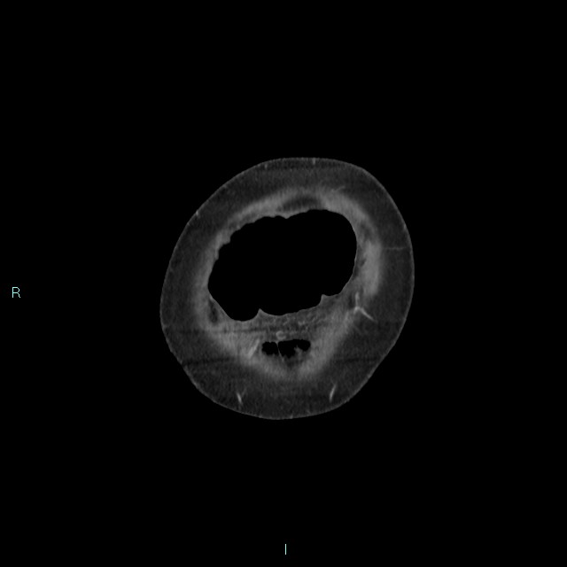 Cecal volvulus (Radiopaedia 71372-81698 C 8).jpg