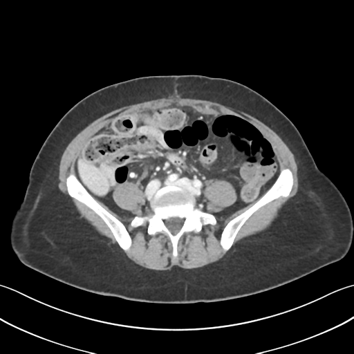 File:Cecum hernia through the foramen of Winslow (Radiopaedia 46634-51112 A 45).png