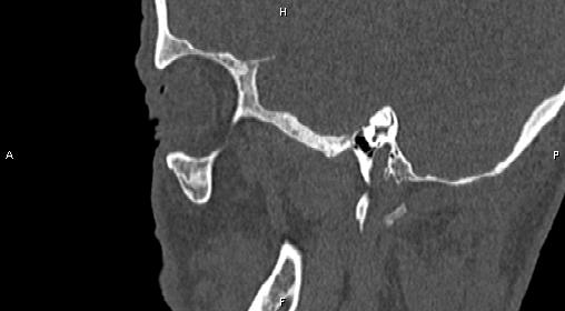 File:Central giant cell granuloma (Radiopaedia 83346-97761 Sagittal bone window 37).jpg