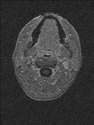 Central neurocytoma (Radiopaedia 56690-63469 Axial T1 C+ 171).jpg