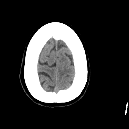 Central neurocytoma (Radiopaedia 65317-74346 Axial non-contrast 44).png