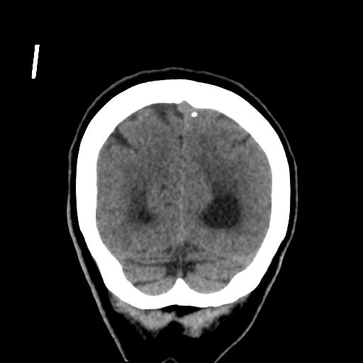 File:Central neurocytoma (Radiopaedia 65317-74346 Coronal non-contrast 51).png