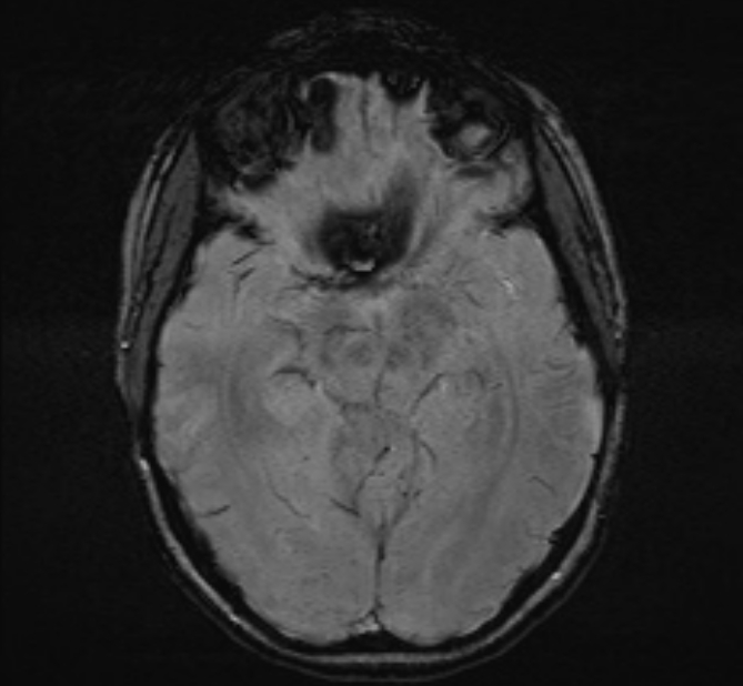Central neurocytoma (Radiopaedia 70263-80336 Axial SWI 23).jpg