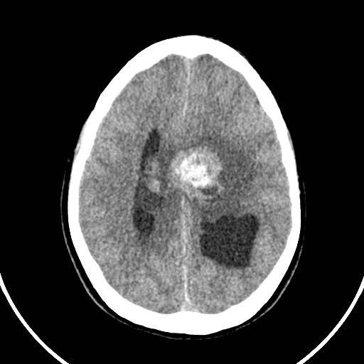 Central neurocytoma (Radiopaedia 84497-99871 Axial non-contrast 34).jpg