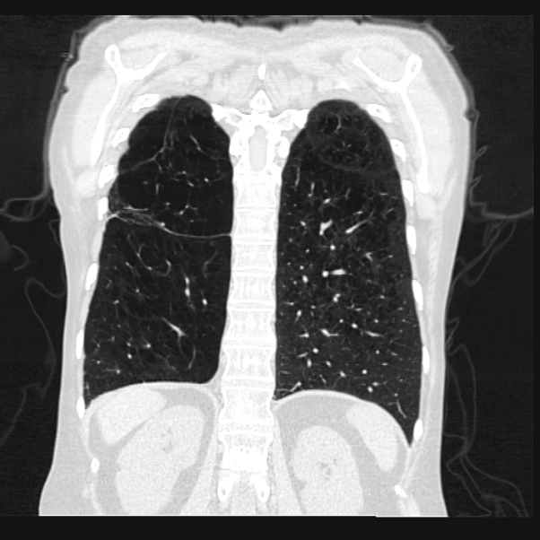 Centrilobular pulmonary emphysema (Radiopaedia 24495-24789 Coronal lung window 59).jpg