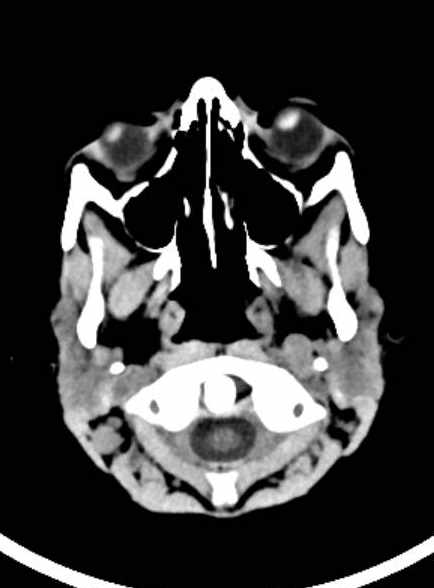 File:Cerebellar abscess (Radiopaedia 73727-84527 Axial non-contrast 17).jpg