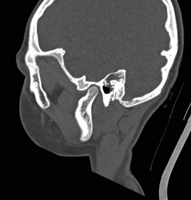 Cerebellar abscess (Radiopaedia 73727-84527 Sagittal bone window 24).jpg
