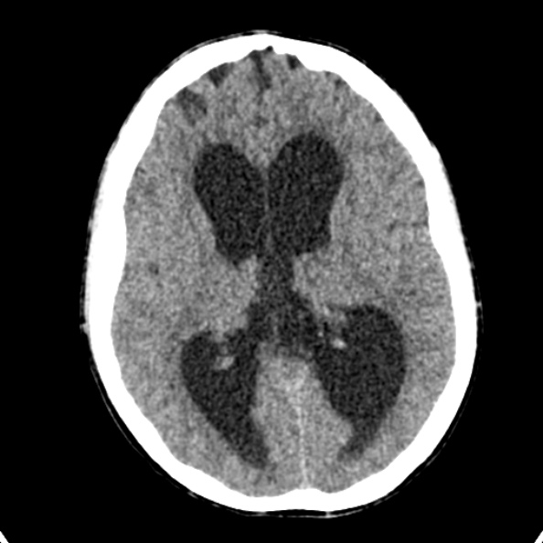 Cerebellar abscess secondary to mastoiditis (Radiopaedia 26284-26412 Axial non-contrast 85).jpg
