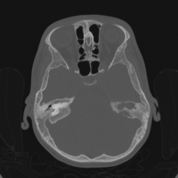 Cerebellar abscess secondary to mastoiditis (Radiopaedia 26284-26413 Axial bone window 65).jpg