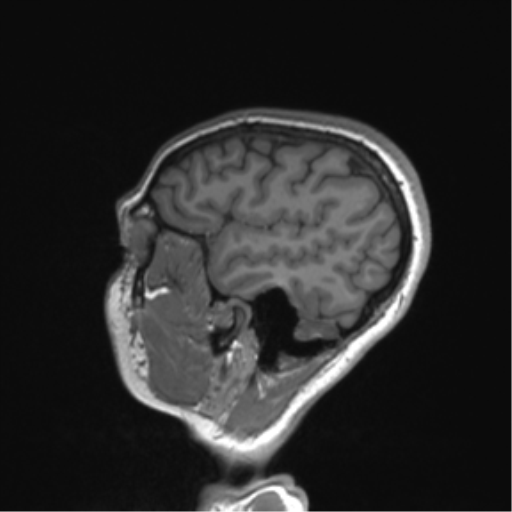 Cerebellar agenesis with hypoplastic pons (pontocerebellar hypoplasia) (Radiopaedia 57224-64138 Sagittal T1 53).png