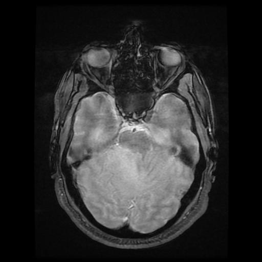 File:Cerebellar hemangioblastoma (Radiopaedia 88055-104622 Axial Gradient Echo 7).jpg