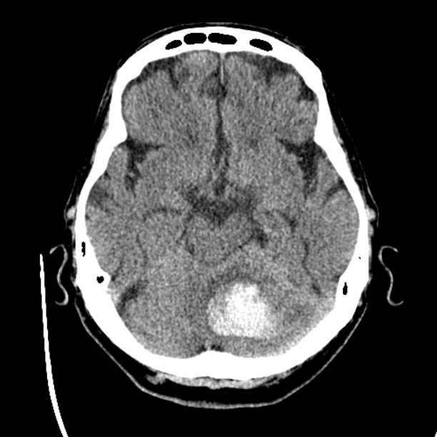 Cerebellar hemorrhage (Radiopaedia 27193-27359 Axial non-contrast 17).jpg