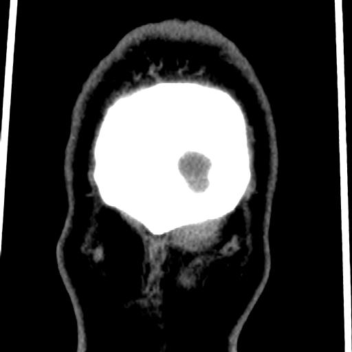Cerebellar infarction (Radiopaedia 16625-16327 Coronal non-contrast 51).jpg