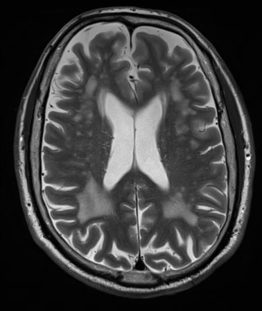 File:Cerebellar metastasis (Radiopaedia 33616-34718 Axial T2 25).png