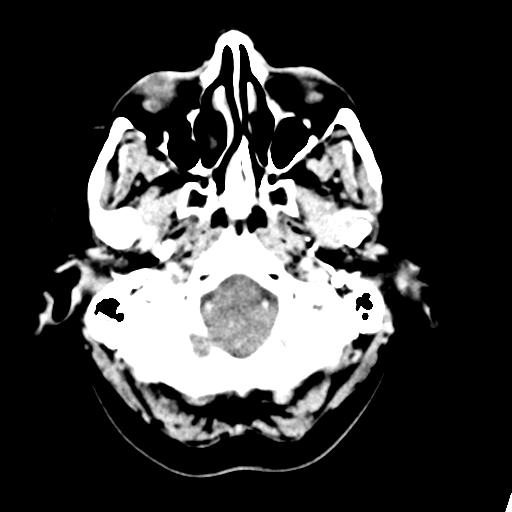 Cerebellar metastasis (Radiopaedia 54578-60812 Axial C+ 6).png