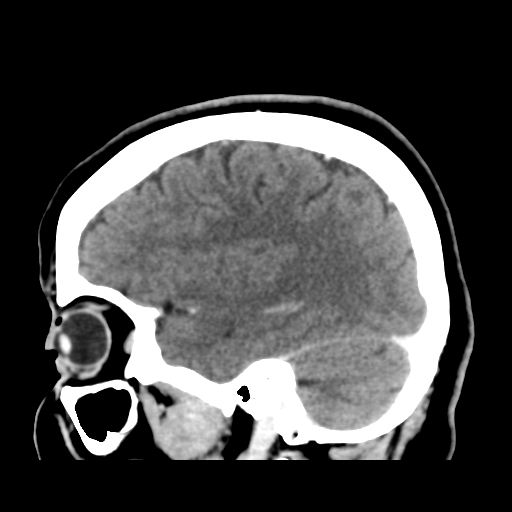 Cerebellar metastasis (cystic appearance) (Radiopaedia 41395-44258 F 16).png