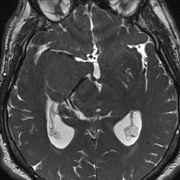 Cerebellopontine angle meningioma (Radiopaedia 24459-24764 I 48).jpg