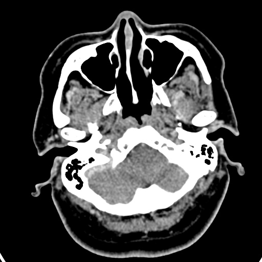 Cerebellopontine angle meningioma (Radiopaedia 35181-36714 A 47).jpg