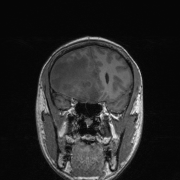 Cerebral abscess (Radiopaedia 24212-24478 Coronal T1 74).jpg