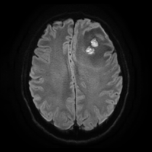 Cerebral abscess (Radiopaedia 57774-64740 Axial DWI 19).png