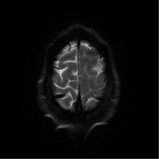File:Cerebral abscess (Radiopaedia 57774-64740 Axial DWI 55).png