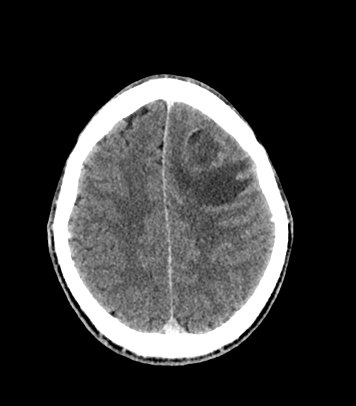 Cerebral abscess (Radiopaedia 57774-64741 Axial C+ delayed 48).png