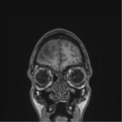 Cerebral abscess (Radiopaedia 60342-68009 Coronal T1 49).png