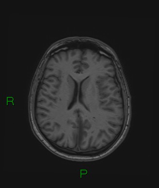 Cerebral abscess and subdural empyema (Radiopaedia 84436-99779 Axial T1 36).jpg