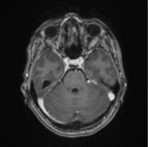 Cerebral abscess from pulmonary arteriovenous malformation (Radiopaedia 86275-102291 Axial T1 C+ 26).png
