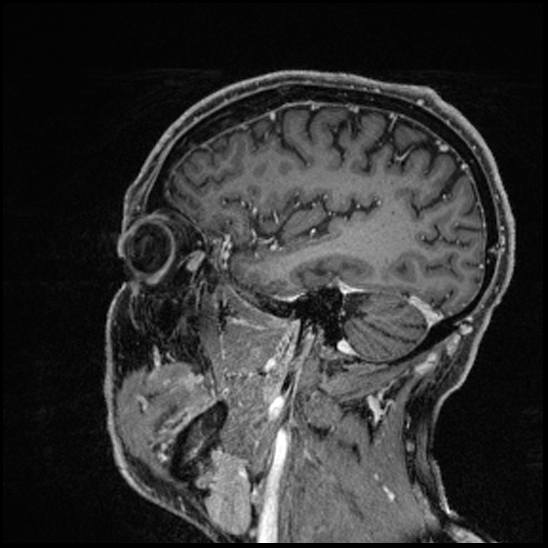 Cerebral abscess with ventriculitis (Radiopaedia 78965-91878 Sagittal T1 C+ 135).jpg