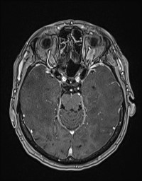 Cerebral amyloid angiopathy-related inflammation (Radiopaedia 58270-65377 Axial T1 C+ fat sat 50).jpg