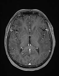 Cerebral amyloid angiopathy-related inflammation (Radiopaedia 58270-65377 Axial T1 C+ fat sat 71).jpg