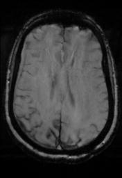 File:Cerebral amyloid angiopathy (Radiopaedia 29129-29518 Axial SWI Magnitude 23).jpg